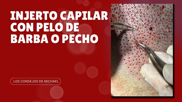BHT en trasplante capilar: injerto capilar con pelo de barba o pecho